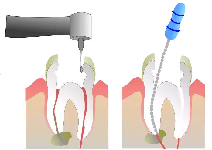 Root Canal Treatment