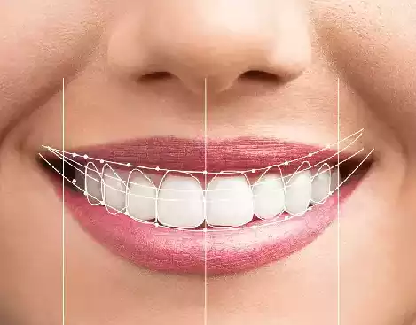 Smile Makeover